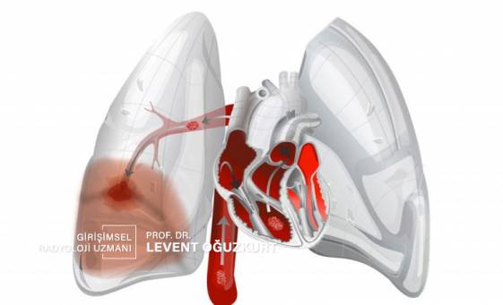 Akciğere pıhtı atması