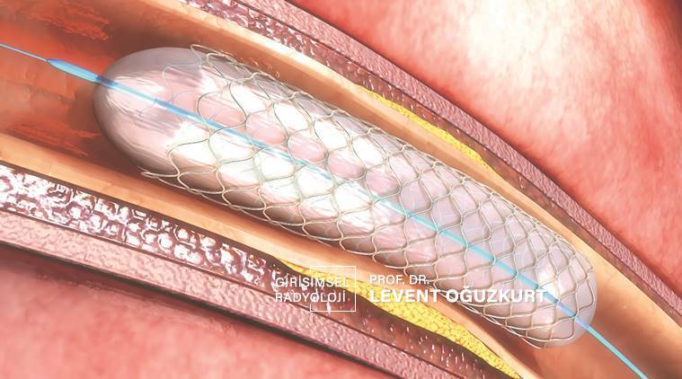 balon ve stent