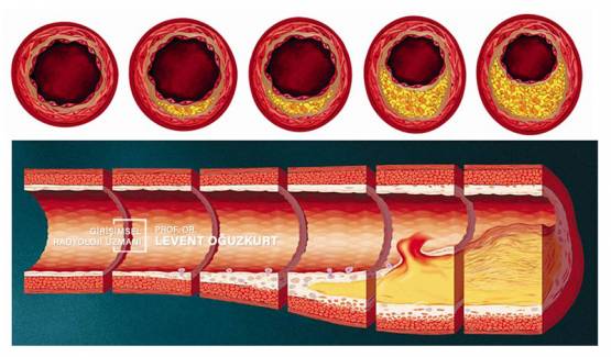 Damar Tıkanıklığı ve Tedavisi