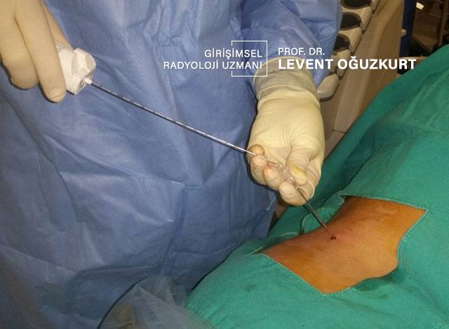 İğne biyopsisi yapılışı