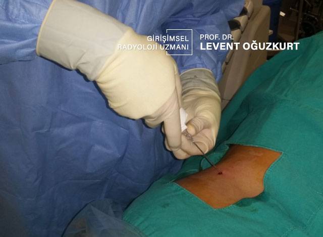 İğne ile çok ince bir doku parçası alınıyor