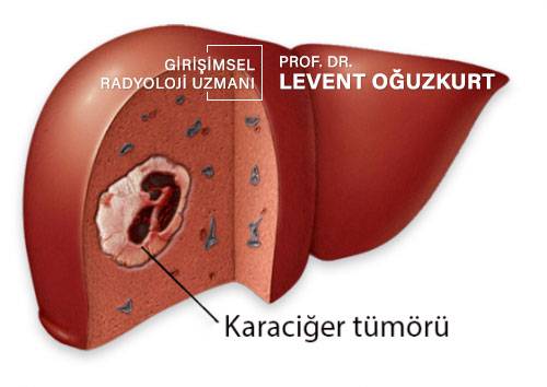 Girişimsel Kanser Tedavisi