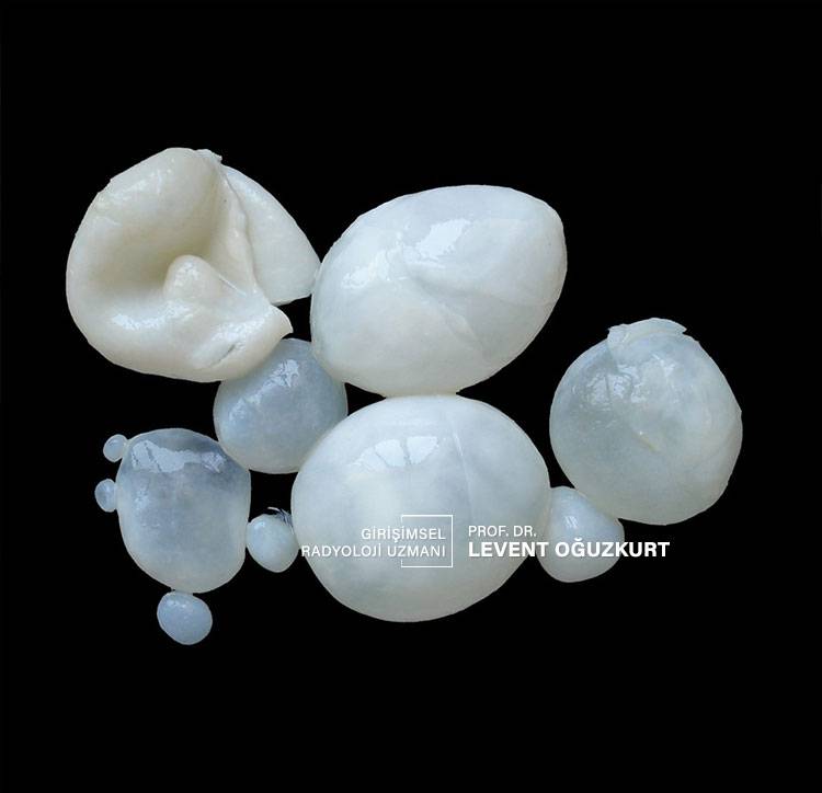 Kist hidatik kistleri