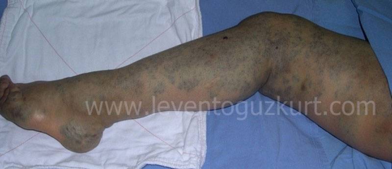 Vasküler Malformasyon